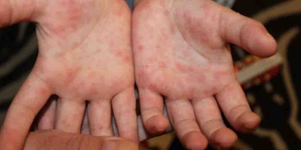 Аллергия на ладонях: причины и возможные объяснения сыпи и зуда